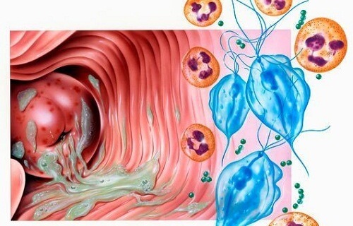 Viêm âm đạo do trùng Trichomonas